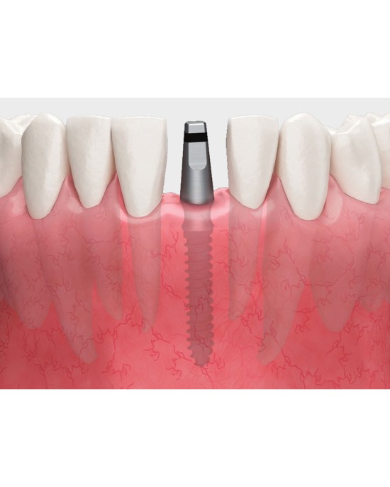 MS Denture & Narrow Ridge MS Denture & Narrow Ridge