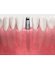 MS Denture & Narrow Ridge MS Denture & Narrow Ridge